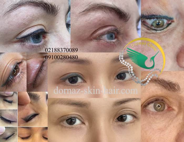 لیزر جای بخیه خط چشم
