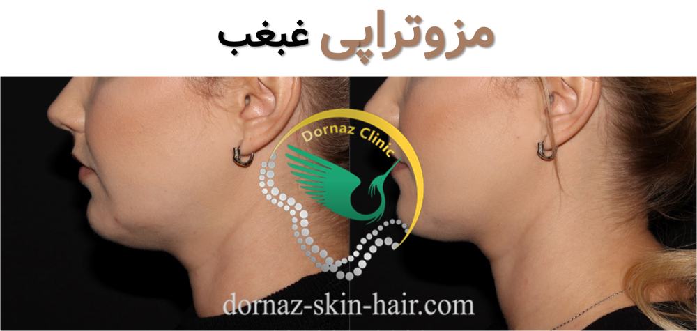 مزوتراپی غبغب