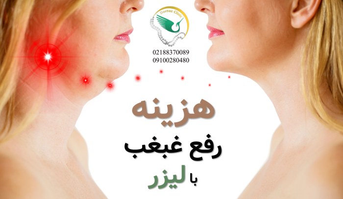 هزینه رفع غبغب با لیزر