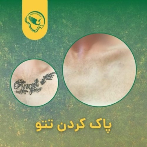 پاک کردن تاتو با لیزر