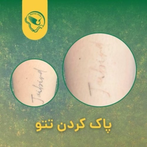 عکس قبل و بعد پاک کردن تتو با لیزر
