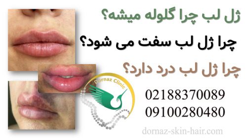 ژل لب چرا گلوله میشه؟چرا ژل لب سفت می شود؟ چرا ژل لب درد دارد؟