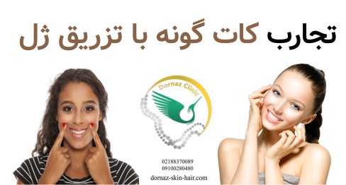 تجارب افراد از کات گونه با تزریق ژل
