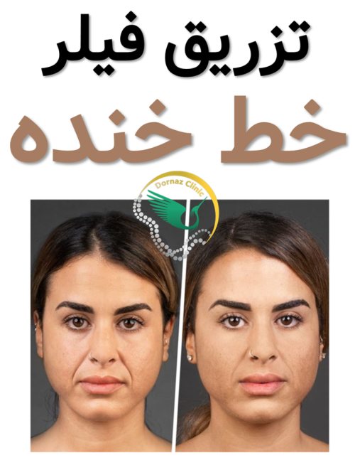 تزریق فیلر خط خنده