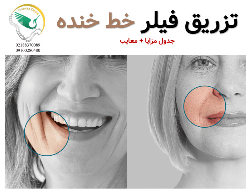 فیلر خط خنده چیست؟ مزایا فیلر خط خنده معایب فیلر خط خنده جدول