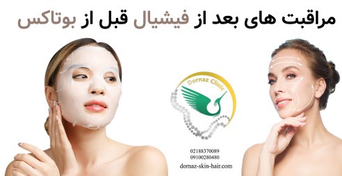 مراقبت های بعد از فیشیال قبل از بوتاکس