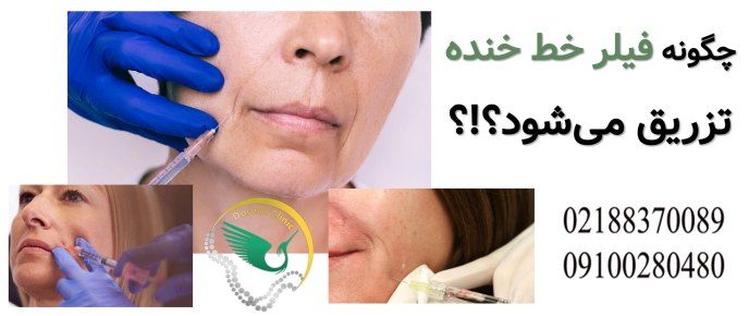 چگونه فیلر خط خنده تزریق می شود؟