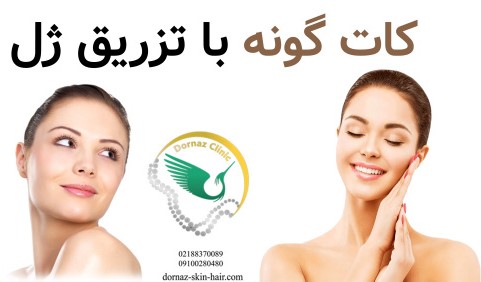 کات گونه با تزریق ژل چگونه است؟