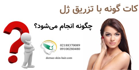 کات گونه با تزریق ژل چگونه انجام می‌شود؟
