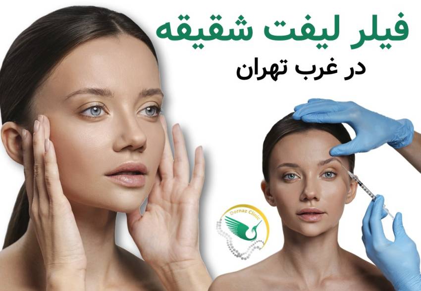 فیلر شقیقه برای لیفت