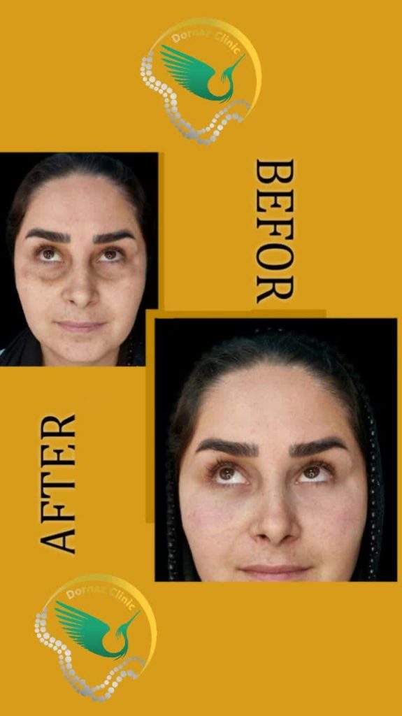 نمونه قبل و بعد فیلر زیرچشم