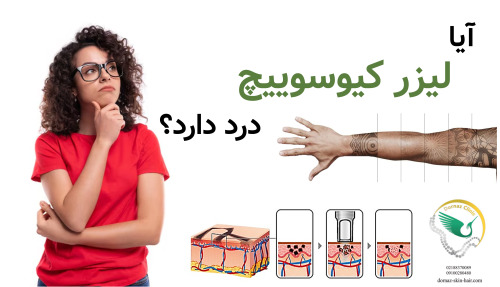 آیا لیزر کیوسوییچ درد دارد؟