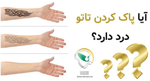 آیا پاک کردن تاتو درد دارد؟