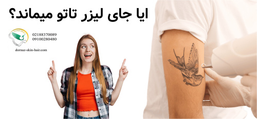 ایا جای لیزر تاتو میماند؟