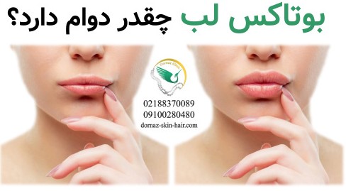 بوتاکس لب چقدر دوام دارد؟