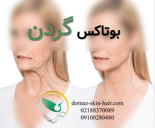 بوتاکس گردن یعنی چه؟