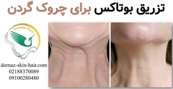 تزریق بوتاکس برای چروک گردن