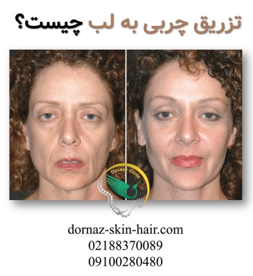 تفاوت تزریق ژل و چربی تفاوت چربی و ژل لب