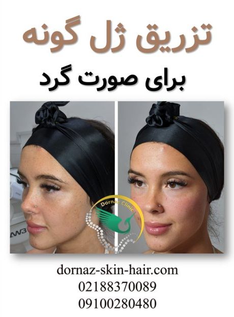تزریق ژل گونه برای صورت گرد