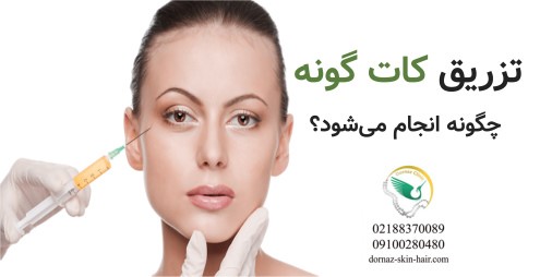 تزریق کات گونه چگونه انجام می‌شود