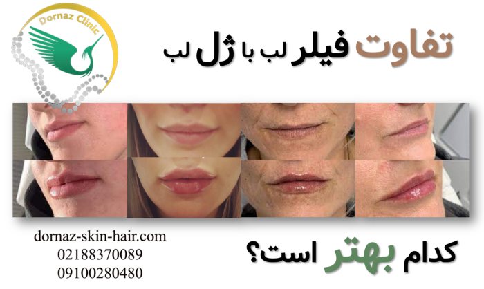 تفاوت فیلر با ژل لب چیست؟ ژل لب بهتر است یا چربی؟