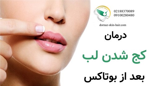 درمان کج شدن لب بعد از بوتاکس