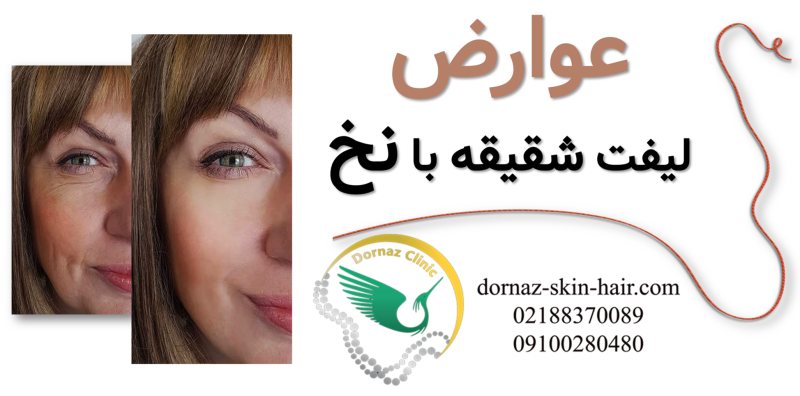 عوارض لیفت با نخ