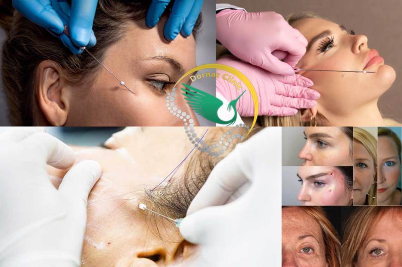 عکس لیفت شقیقه با نخ