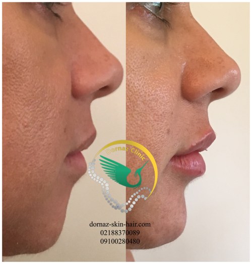 عکس قبل و بعدتزریق ژل چانه