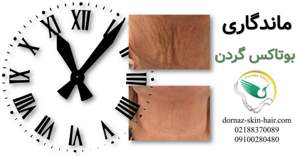 ماندگاری بوتاکس گردن