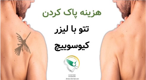 هزینه پاک کردن تتو با لیزر کیوسوییچ