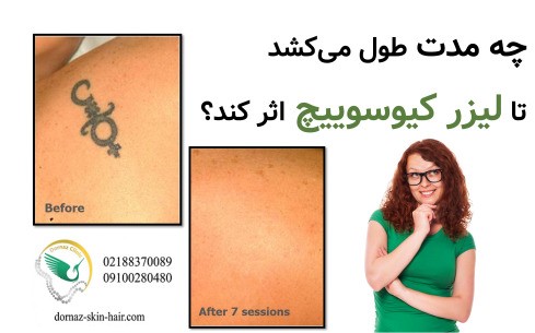 چه مدت طول می‌کشد تا لیزر کیوسوییچ اثر کند؟