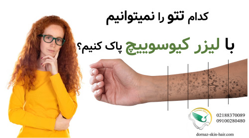کدام تتو را نمیتوانیم با لیزر کیوسوییچ پاک کنیم؟