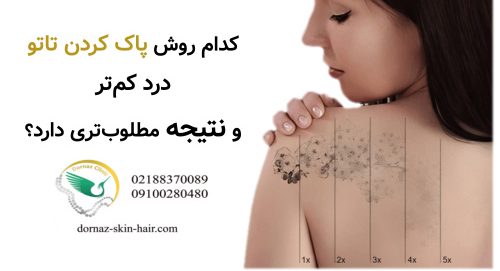 کدام روش پاک کردن تاتو درد کم‌تر و نتیجه مطلوب‌تری دارد؟