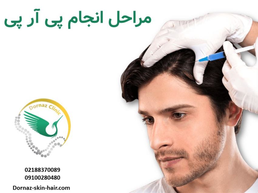 مراحل پی آر پی مو و صورت