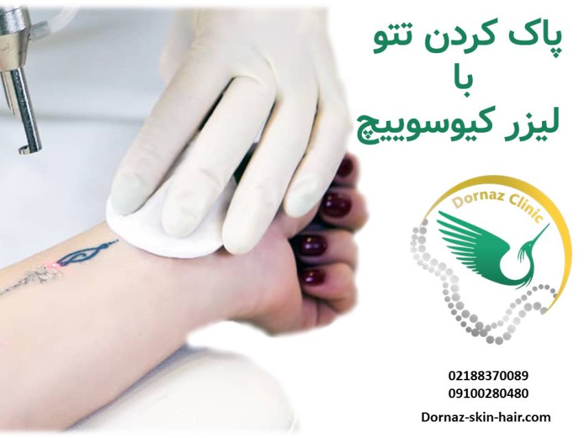 پاک کردن تتو با لیزر کیوسوییچ