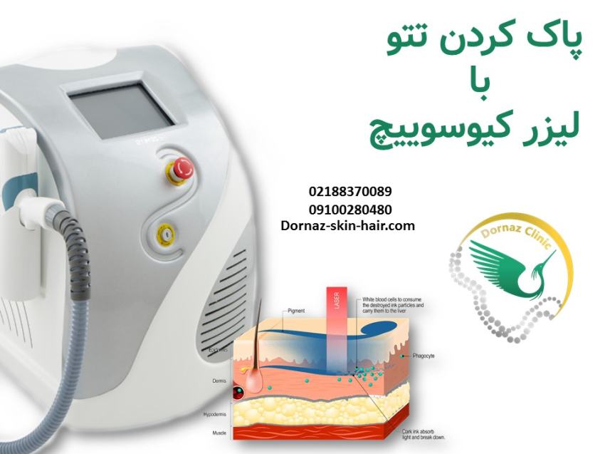 پاک کردن تتو