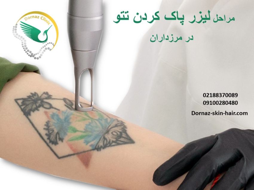 مراحل لیزر کیوسوییچ