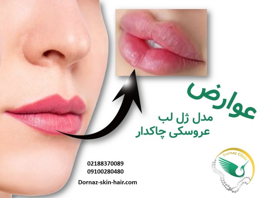 عوارض فیلر لب