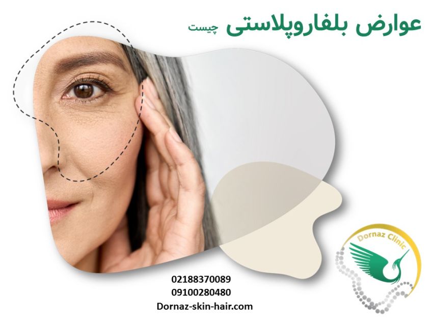 عوارض بلفاروپلاستی