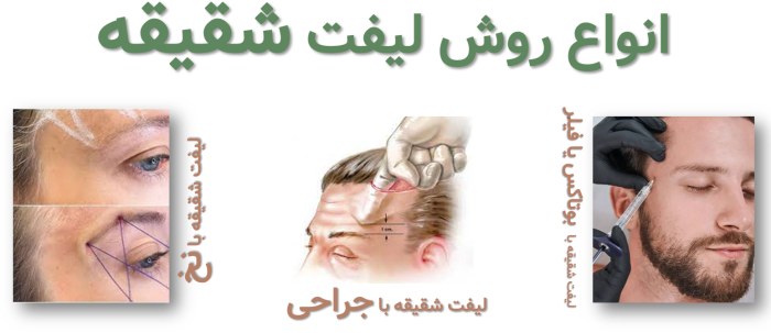 انواع روش های لیفت شقیقه 