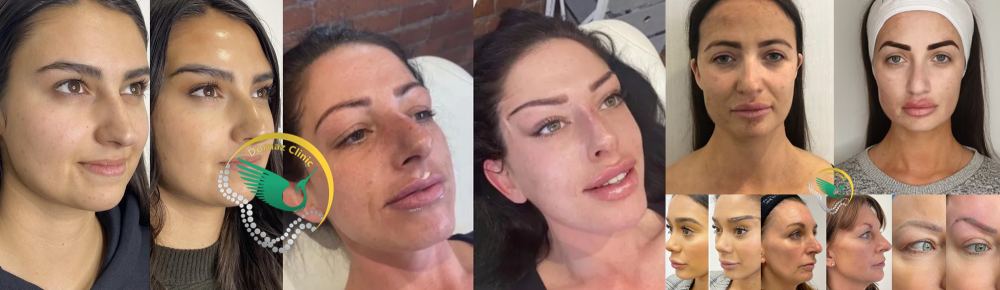 عکس قبل و بعد لیفت با نخ