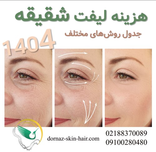 قیمت لیفت شقیقه با نخ