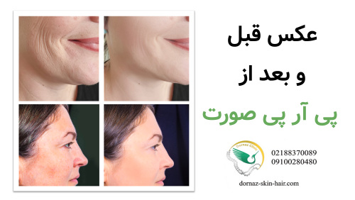 عکس قبل و بعد از پی آر پی صورت
