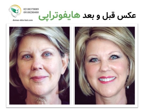 عکس قبل و بعد هایفوتراپی