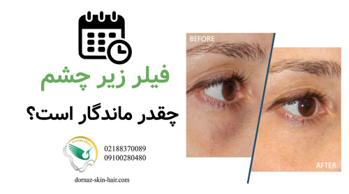 فیلر زیر چشم چقدر ماندگار است؟