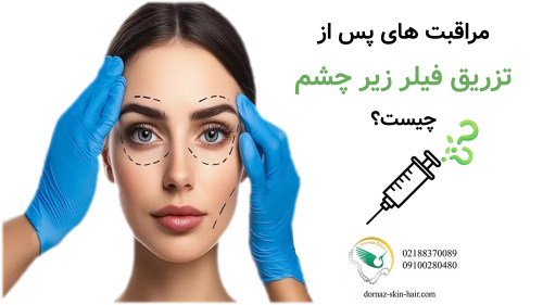 مراقبت های پس از تزریق فیلر زیر چشم چیست؟