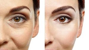 کاربرد و مزایای کربوکسی تراپی